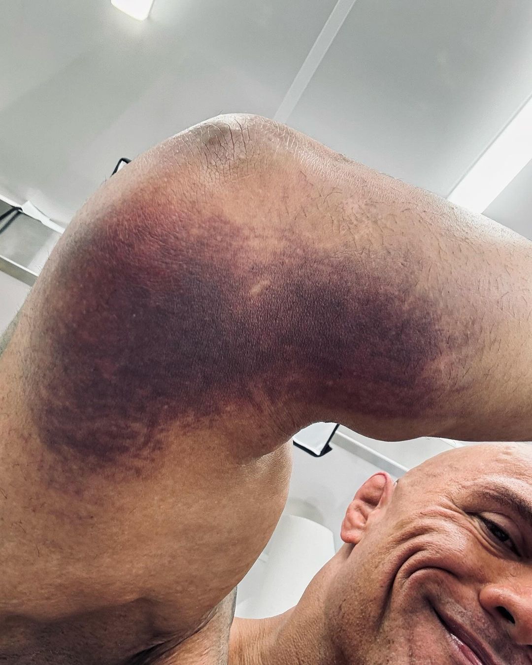 Dwayne Johnson elbow injury