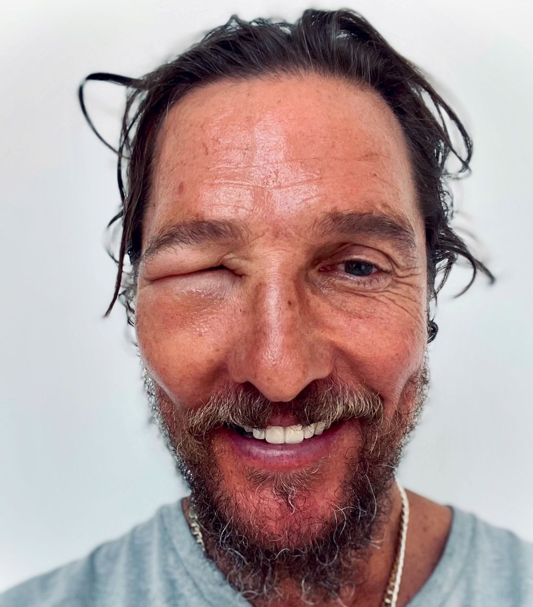 Matthew McConaughey Struggles with Swollen Eye After Bee Sting Incident