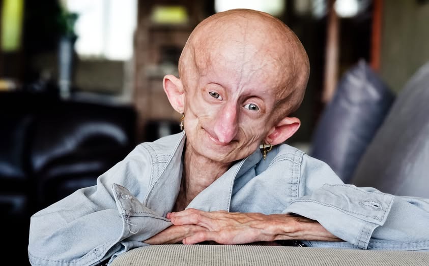 TikTok Star Beandri Booysen Dies at age 19 from Rare Aging Disease